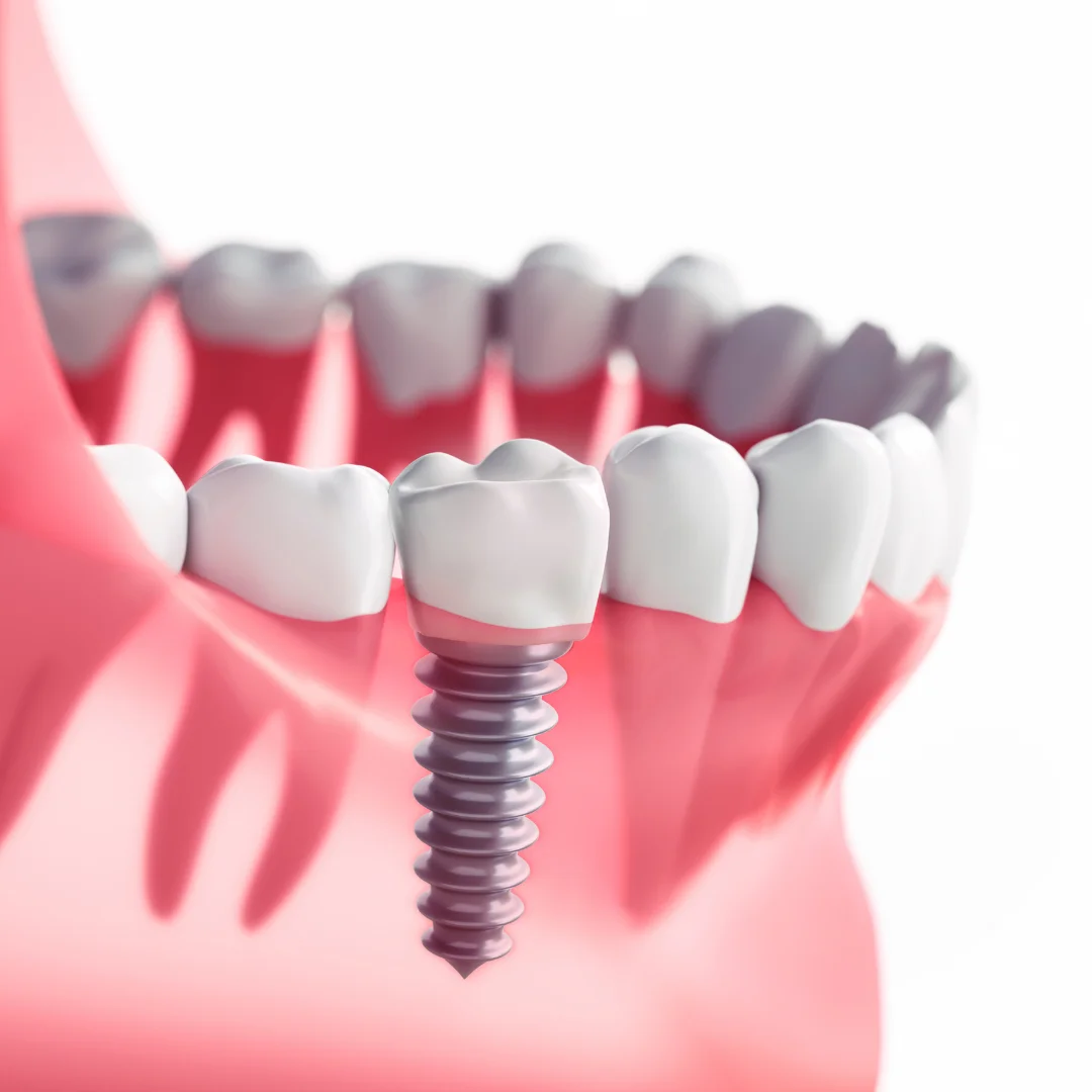 Dental Implants