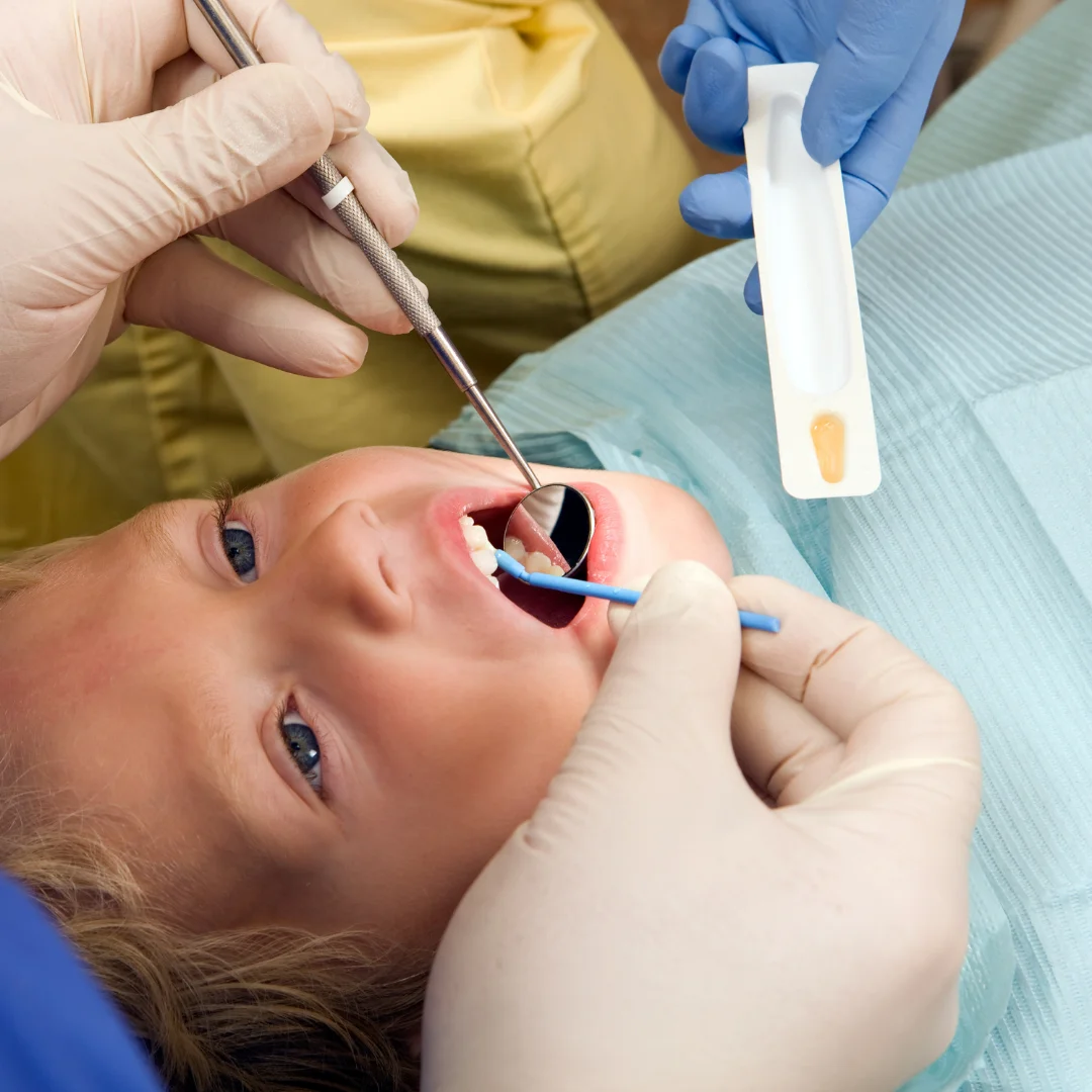 Professional fluoride treatment at Glendale Dental Wellness