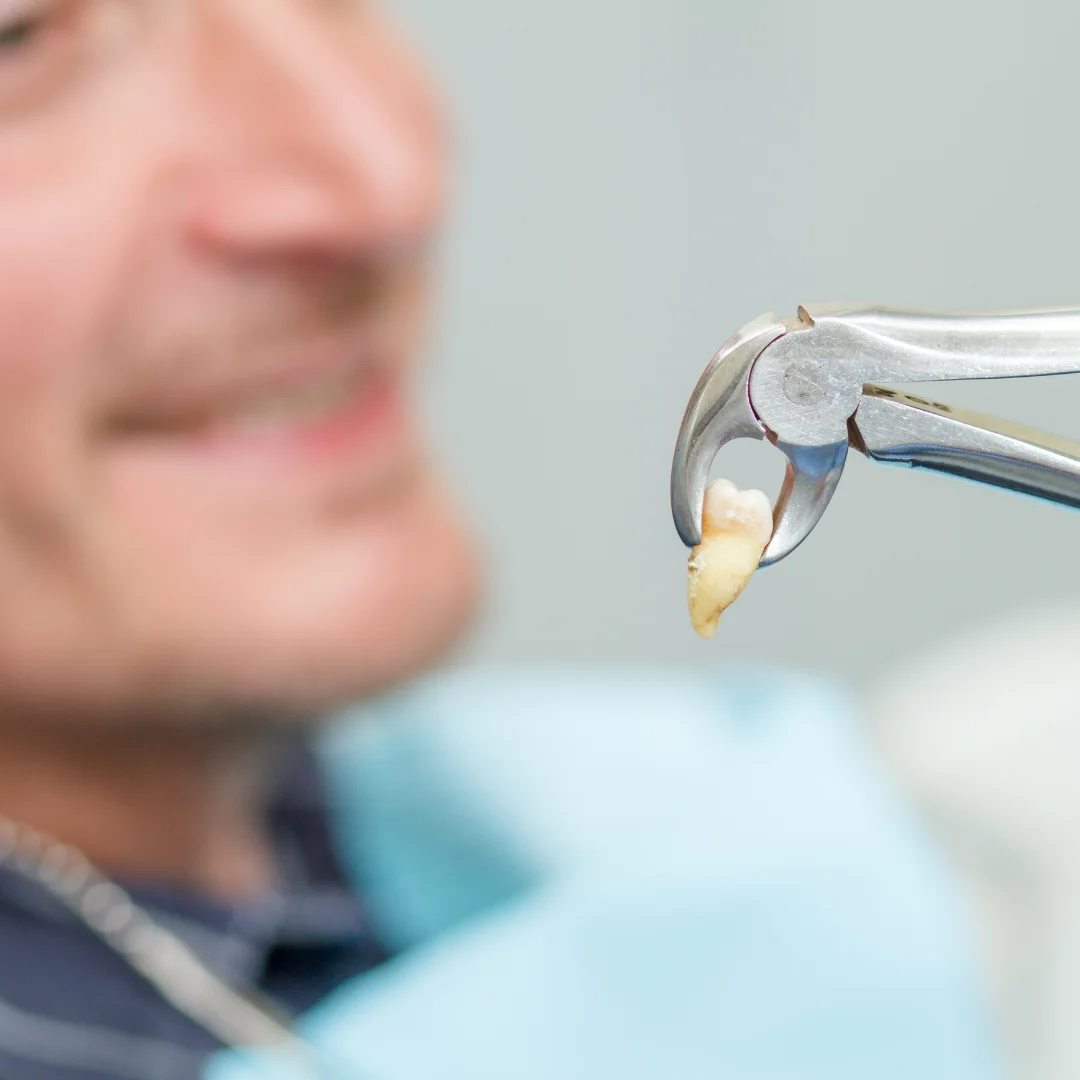 Tooth Extractions