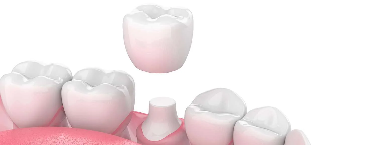 Restorative dentistry services at Glendale Dental Wellness
